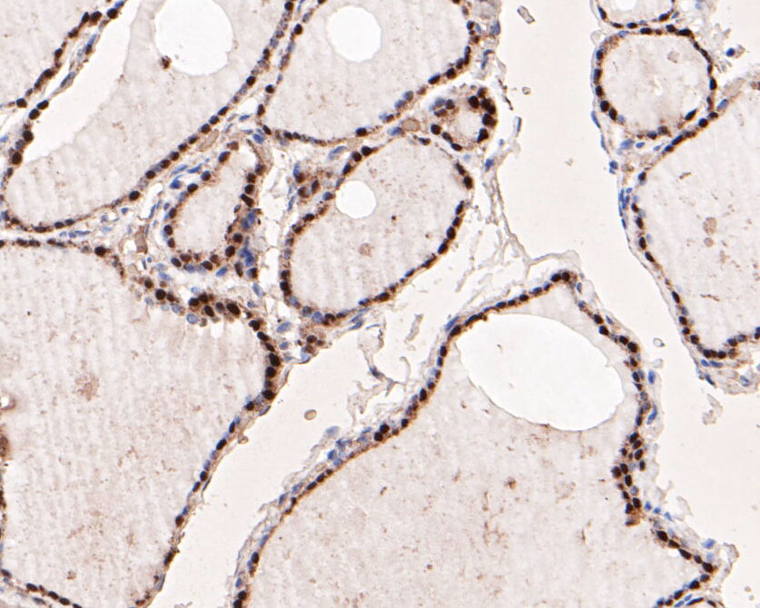Immunohistochemical analysis of paraffin-embedded human thyroid gland tissue using anti-PAX8 antibody. The section was pre-treated using heat mediated antigen retrieval with Tris-EDTA buffer (pH 8.0-8.4) for 20 minutes.The tissues were blocked in 5% BSA for 30 minutes at room temperature, washed with ddH2O and PBS, and then probed with the primary antibody (EM1902-22, 1/200) for 30 minutes at room temperature. The detection was performed using an HRP conjugated compact polymer system. DAB was used as the chromogen. Tissues were counterstained with hematoxylin and mounted with DPX.