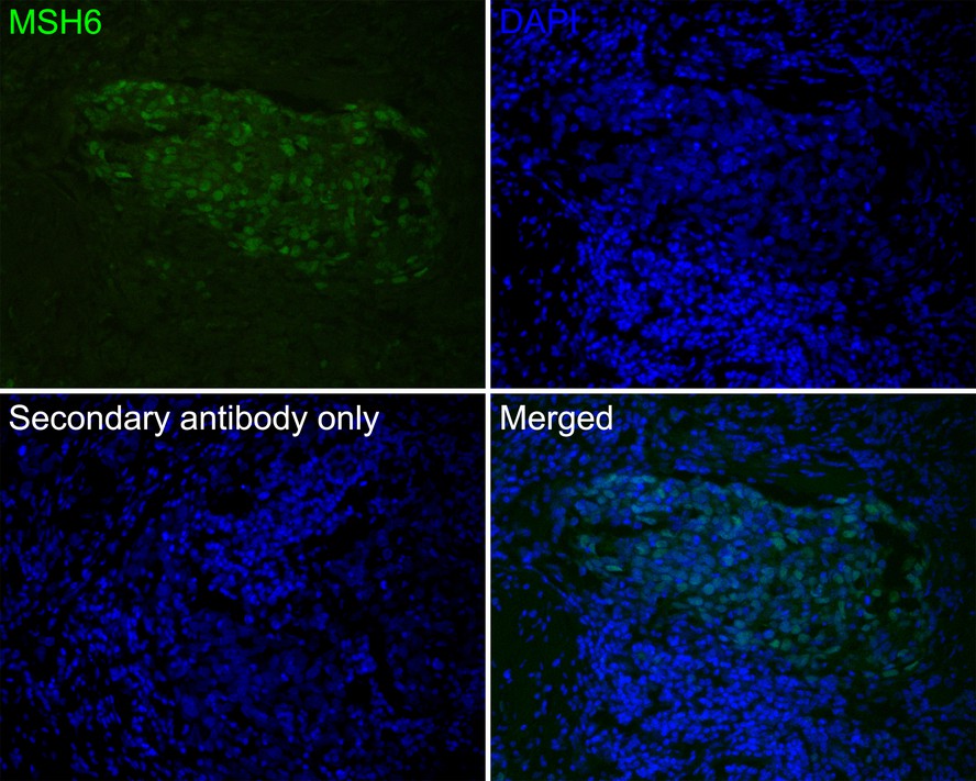 Immunofluorescence analysis of paraffin-embedded human breast carcinoma tissue labeling MSH6 with Mouse anti-MSH6 antibody (EM1902-24) at 1/50 dilution.<br />
<br />
The section was pre-treated using heat mediated antigen retrieval with Tris-EDTA buffer (pH 9.0) for 20 minutes. The tissues were blocked in 10% negative goat serum for 1 hour at room temperature, washed with PBS, and then probed with the primary antibody (EM1902-24, green) at 1/50 dilution overnight at 4 ℃, washed with PBS.<br />
<br />
Goat Anti-Mouse IgG H&L (Alexa Fluor® 488) was used as the secondary antibody at 1/1,000 dilution. Nuclei were counterstained with DAPI (blue).
