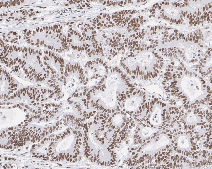 Immunohistochemical analysis of paraffin-embedded human colon carcinoma tissue using anti-MSH6 antibody. The section was pre-treated using heat mediated antigen retrieval with sodium citrate buffer (pH 6.0) for 20 minutes. The tissues were blocked in 5% BSA for 30 minutes at room temperature, washed with ddH2O and PBS, and then probed with the primary antibody (EM1902-24, 1/200)  for 30 minutes at room temperature. The detection was performed using an HRP conjugated compact polymer system. DAB was used as the chromogen. Tissues were counterstained with hematoxylin and mounted with DPX.
