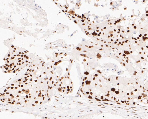 Immunohistochemical analysis of paraffin-embedded human breast carcinoma tissue using anti-MSH6 antibody. The section was pre-treated using heat mediated antigen retrieval with sodium citrate buffer (pH 6.0) for 20 minutes. The tissues were blocked in 5% BSA for 30 minutes at room temperature, washed with ddH2O and PBS, and then probed with the primary antibody (EM1902-24, 1/200)  for 30 minutes at room temperature. The detection was performed using an HRP conjugated compact polymer system. DAB was used as the chromogen. Tissues were counterstained with hematoxylin and mounted with DPX.