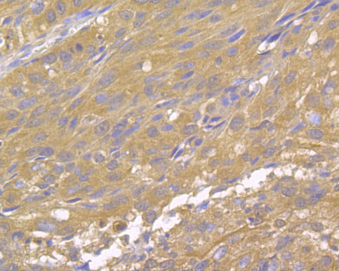 Immunohistochemical analysis of paraffin-embedded human lung cancer tissue using anti-DAP Kinase 1 antibody. The section was pre-treated using heat mediated antigen retrieval with Tris-EDTA buffer (pH 8.0-8.4) for 20 minutes.The tissues were blocked in 5% BSA for 30 minutes at room temperature, washed with ddH2O and PBS, and then probed with the primary antibody (EM1902-25, 1/100) for 30 minutes at room temperature. The detection was performed using an HRP conjugated compact polymer system. DAB was used as the chromogen. Tissues were counterstained with hematoxylin and mounted with DPX.