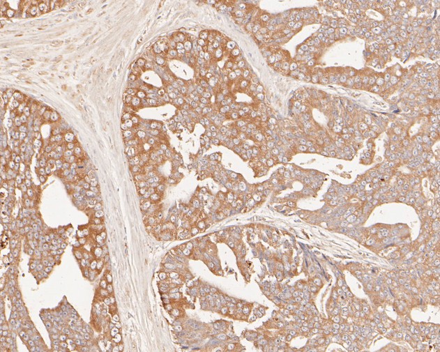 Immunohistochemical analysis of paraffin-embedded human prostate carcinoma tissue using anti-GADD34 antibody. The section was pre-treated using heat mediated antigen retrieval with Tris-EDTA buffer (pH 8.0-8.4) for 20 minutes.The tissues were blocked in 5% BSA for 30 minutes at room temperature, washed with ddH2O and PBS, and then probed with the primary antibody (EM1902-26, 1/100) for 30 minutes at room temperature. The detection was performed using an HRP conjugated compact polymer system. DAB was used as the chromogen. Tissues were counterstained with hematoxylin and mounted with DPX.