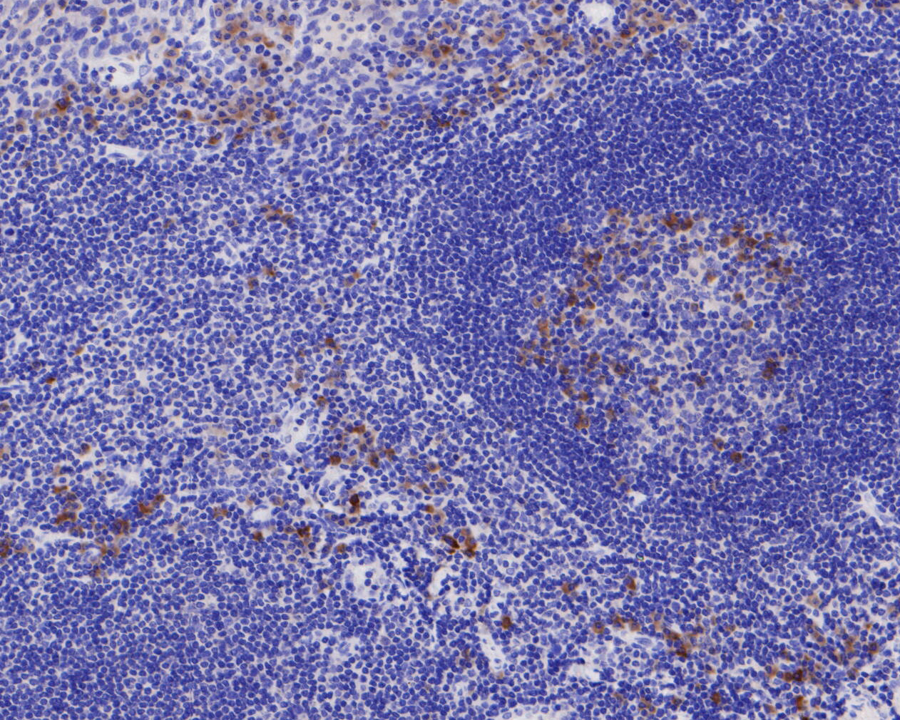 Immunohistochemical analysis of paraffin-embedded human tonsil tissue using anti-YKL-40/CHI3L1 antibody. The section was pre-treated using heat mediated antigen retrieval with Tris-EDTA buffer (pH 8.0-8.4) for 20 minutes.The tissues were blocked in 5% BSA for 30 minutes at room temperature, washed with ddH2O and PBS, and then probed with the primary antibody (EM1902-31, 1/400) for 30 minutes at room temperature. The detection was performed using an HRP conjugated compact polymer system. DAB was used as the chromogen. Tissues were counterstained with hematoxylin and mounted with DPX.