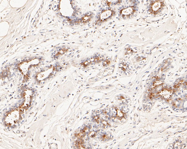Immunohistochemical analysis of paraffin-embedded human breast tissue using anti-MUC1 antibody. The section was pre-treated using heat mediated antigen retrieval with sodium citrate buffer (pH 6.0) for 20 minutes. The tissues were blocked in 5% BSA for 30 minutes at room temperature, washed with ddH2O and PBS, and then probed with the primary antibody (EM1902-32, 1/100)  for 30 minutes at room temperature. The detection was performed using an HRP conjugated compact polymer system. DAB was used as the chromogen. Tissues were counterstained with hematoxylin and mounted with DPX.