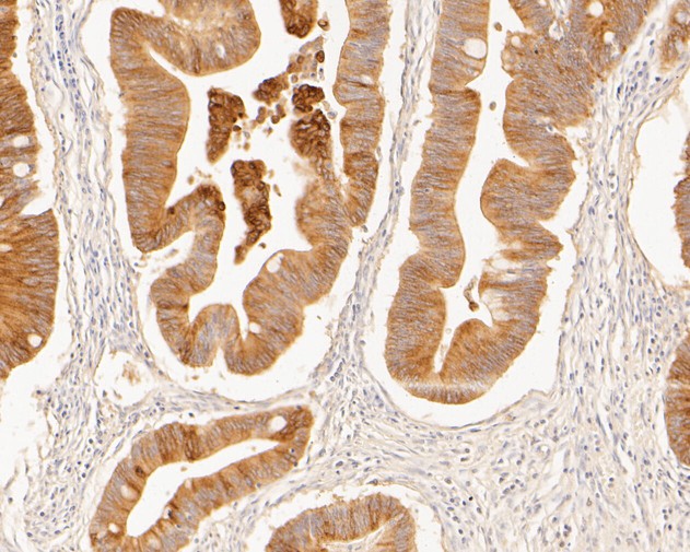 Immunohistochemical analysis of paraffin-embedded human colon carcinoma tissue using anti-MUC1 antibody. The section was pre-treated using heat mediated antigen retrieval with Tris-EDTA buffer (pH 8.0-8.4) for 20 minutes.The tissues were blocked in 5% BSA for 30 minutes at room temperature, washed with ddH2O and PBS, and then probed with the primary antibody (EM1902-32, 1/50) for 30 minutes at room temperature. The detection was performed using an HRP conjugated compact polymer system. DAB was used as the chromogen. Tissues were counterstained with hematoxylin and mounted with DPX.