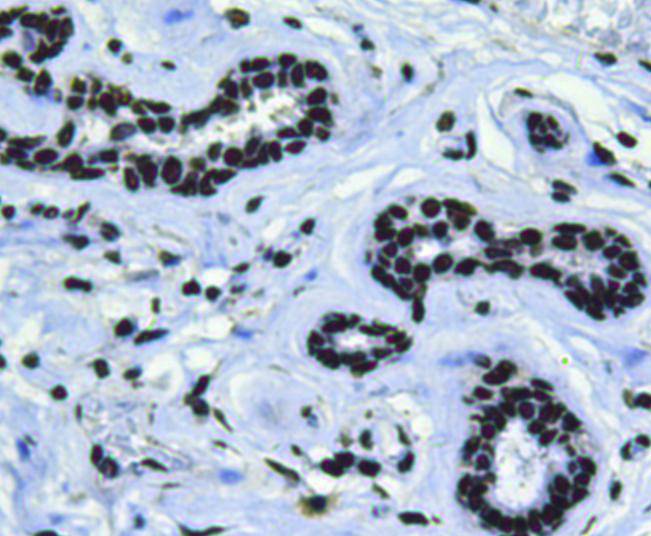 Immunohistochemical analysis of paraffin-embedded human breast cancer tissue using anti-BMI1 antibody. Counter stained with hematoxylin.
