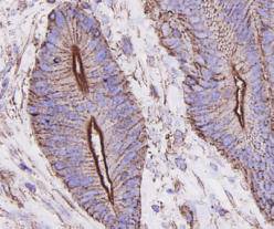 Immunohistochemical analysis of paraffin-embedded human colon carcinoma tissue using anti-Beta Actin antibody. The section was pre-treated using heat mediated antigen retrieval with Tris-EDTA buffer (pH 9.0) for 20 minutes.The tissues were blocked in 1% BSA for 30 minutes at room temperature, washed with ddH2O and PBS, and then probed with the primary antibody (EM21002, 1/50) for 30 minutes at room temperature. The detection was performed using an HRP conjugated compact polymer system. DAB was used as the chromogen. Tissues were counterstained with hematoxylin and mounted with DPX.