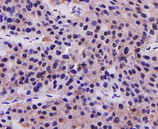 Immunohistochemical analysis of paraffin-embedded human liver tissue using anti-PRMT5 antibody. Counter stained with hematoxylin.