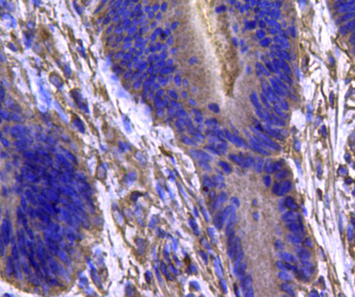 Immunohistochemical analysis of paraffin-embedded human colon carcinoma tissue using anti-IDH1 antibody. Counter stained with hematoxylin.