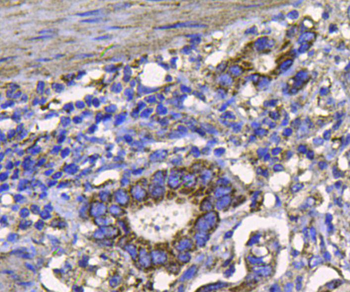 Immunohistochemical analysis of paraffin-embedded human stomach carcinoma tissue using anti-FGFR2 antibody. Counter stained with hematoxylin.