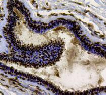 Immunohistochemical analysis of paraffin-embedded human breast cancer tissue using anti-Ku70 antibody. Counter stained with hematoxylin.