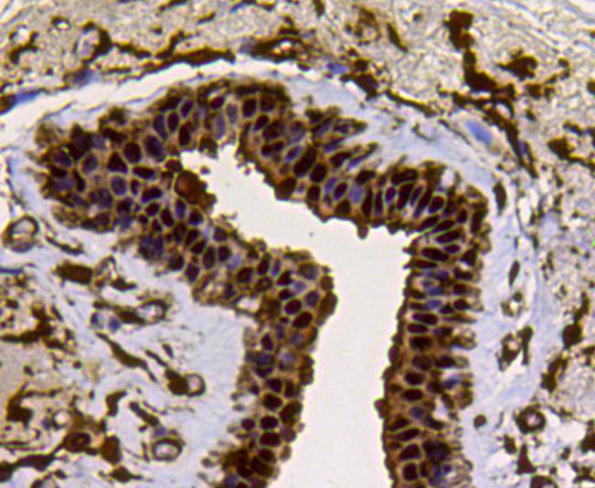 Immunohistochemical analysis of paraffin-embedded human breast carcinoma tissue using anti-LDHA antibody. The section was pre-treated using heat mediated antigen retrieval with Tris-EDTA buffer (pH 9.0) for 20 minutes.The tissues were blocked in 1% BSA for 30 minutes at room temperature, washed with ddH2O and PBS, and then probed with the primary antibody (ER00702, 1/50) for 30 minutes at room temperature. The detection was performed using an HRP conjugated compact polymer system. DAB was used as the chromogen. Tissues were counterstained with hematoxylin and mounted with DPX.