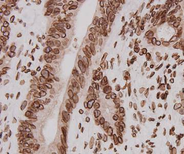 Immunohistochemical analysis of paraffin-embedded human colon carcinoma tissue using anti-LMNB2 antibody. Counter stained with hematoxylin.