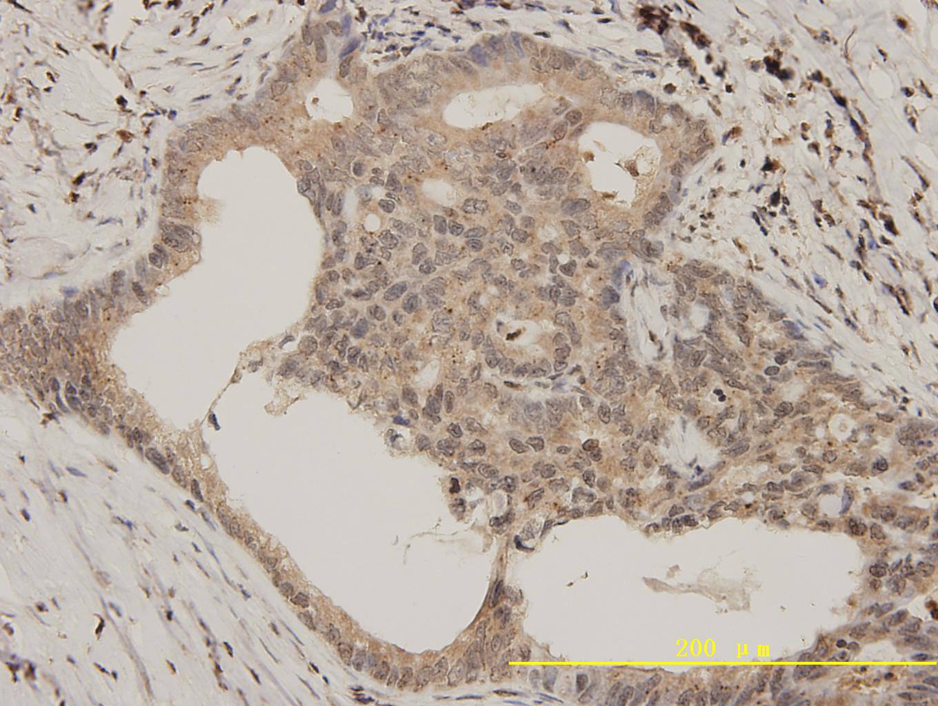 Immunohistochemical analysis of paraffin-embedded human colon carcinoma tissue using anti-Bcl-2 rabbit polyclonal antibody. Counter stained with hematoxylin.