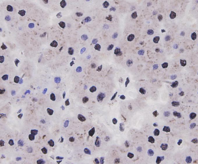 Immunohistochemical analysis of paraffin-embedded human liver carcinoma tissue using anti-Cyclin D1 antibody. Counter stained with hematoxylin.