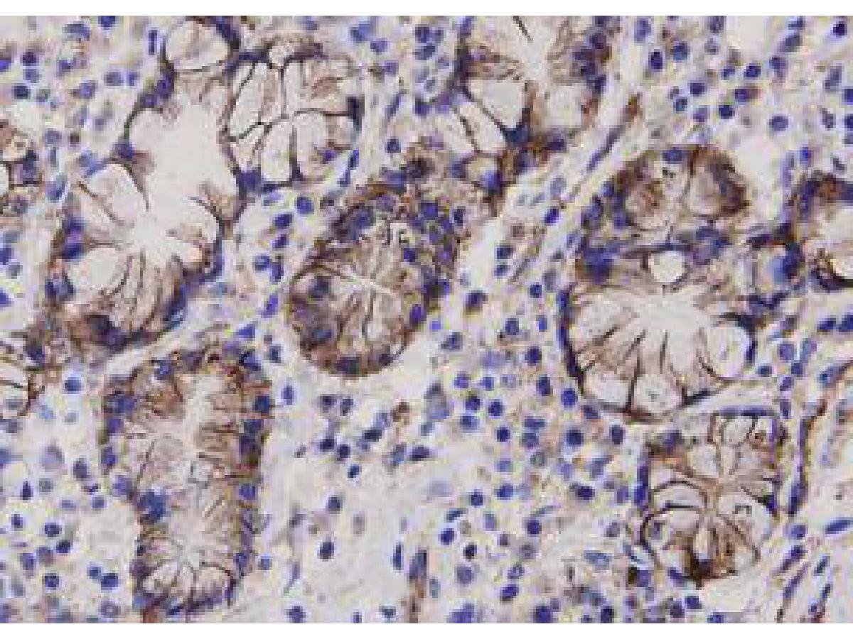 Immunohistochemical analysis of paraffin-embedded human lung carcinoma tissue using anti-Beta-Catenin antibody. The section was pre-treated using heat mediated antigen retrieval with Tris-EDTA buffer (pH 8.0-8.4) for 20 minutes.The tissues were blocked in 5% BSA for 30 minutes at room temperature, washed with ddH2O and PBS, and then probed with the primary antibody (ER0805, 1/50) for 30 minutes at room temperature. The detection was performed using an HRP conjugated compact polymer system. DAB was used as the chromogen. Tissues were counterstained with hematoxylin and mounted with DPX.