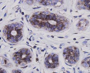 Immunohistochemical analysis of paraffin-embedded human breast carcinoma tissue using anti-NF-κB p65 antibody. Counter stained with hematoxylin.