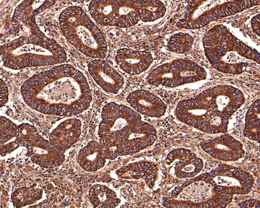 Immunohistochemical analysis of paraffin-embedded human cervical tissue using anti-Bax antibody. Counter stained with hematoxylin.