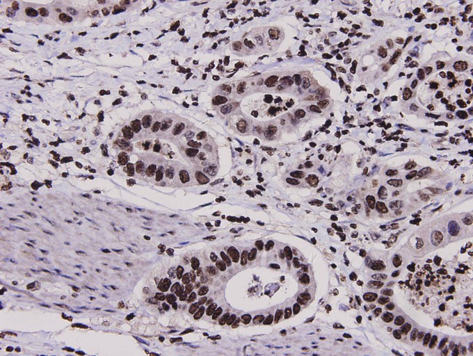 Immunohistochemical analysis of paraffin-embedded human stomach carcinoma tissue using anti- HMGB1 antibody. Counter stained with hematoxylin.