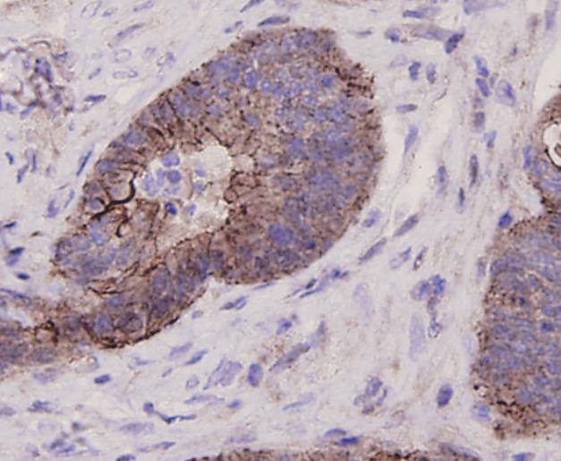Immunohistochemical analysis of paraffin-embedded human colon cancer tissue using anti-LGR5 antibody. Counter stained with hematoxylin.