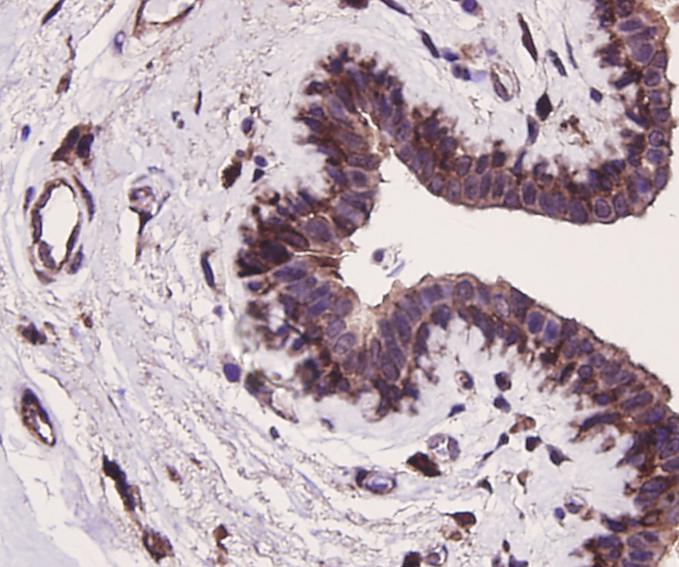 Immunohistochemical analysis of paraffin-embedded human breast cancer tissue using anti-ERK2 antibody. The section was pre-treated using heat mediated antigen retrieval with Tris-EDTA buffer (pH 8.0-8.4) for 20 minutes.The tissues were blocked in 5% BSA for 30 minutes at room temperature, washed with ddH2O and PBS, and then probed with the antibody (ER131218) at 1/100 dilution, for 30 minutes at room temperature and detected using an HRP conjugated compact polymer system. DAB was used as the chrogen. Counter stained with hematoxylin and mounted with DPX.