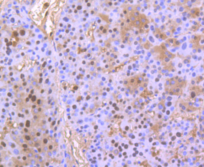 Immunohistochemical analysis of paraffin-embedded human liver cancer tissue using anti-PHF10 antibody. Counter stained with hematoxylin.