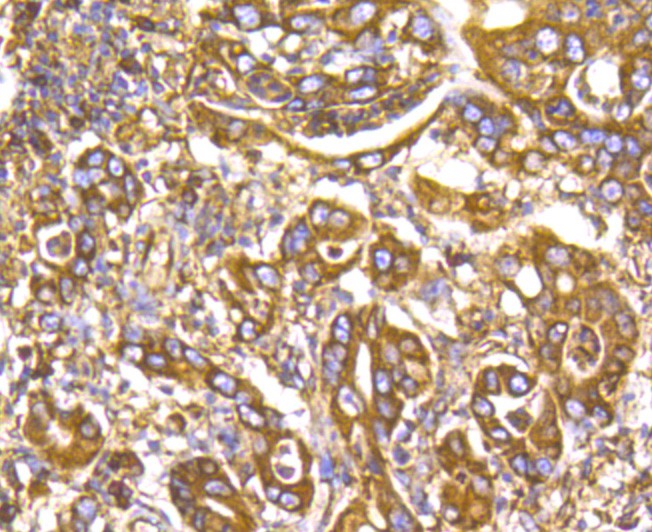 Immunohistochemical analysis of paraffin-embedded human stomach cancer tissue using anti-GRP94 antibody. Counter stained with hematoxylin.