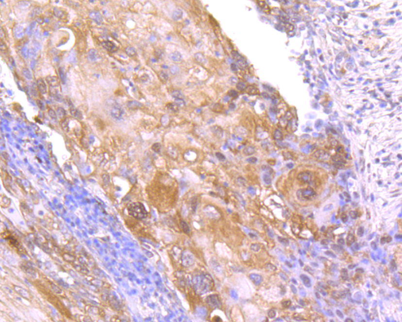 Immunohistochemical analysis of paraffin-embedded human lung cancer tissue using anti-NM23 antibody. Counter stained with hematoxylin.