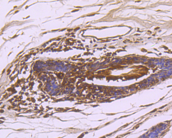 Immunohistochemical analysis of paraffin-embedded human breast cancer tissue using anti-NM23 antibody. Counter stained with hematoxylin.