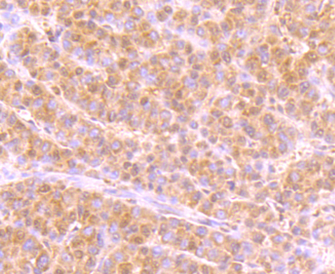 Immunohistochemical analysis of paraffin-embedded human liver cancer tissue using anti-USP36 antibody. Counter stained with hematoxylin.