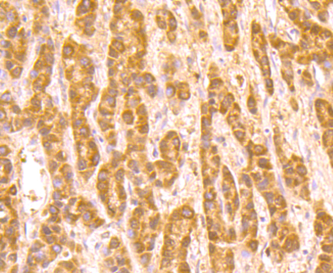 Immunohistochemical analysis of paraffin-embedded human liver cancer tissue using anti-ROBO1 antibody. Counter stained with hematoxylin.