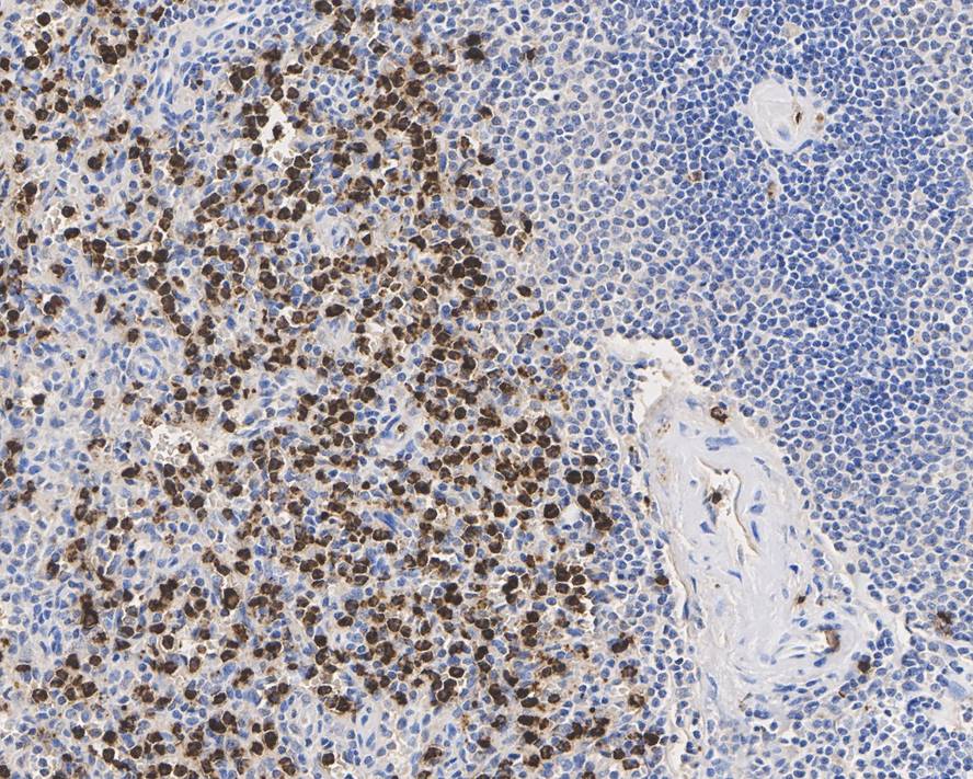 Immunohistochemical analysis of paraffin-embedded human lung cancer tissue using anti-PRTN3 antibody. Counter stained with hematoxylin.