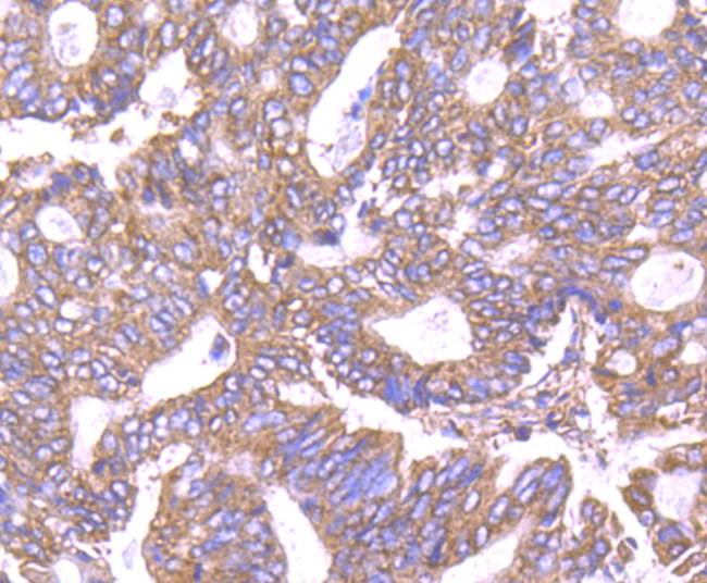 Immunohistochemical analysis of paraffin-embedded human colon cancer tissue using anti-PP2C alpha antibody. Counter stained with hematoxylin.