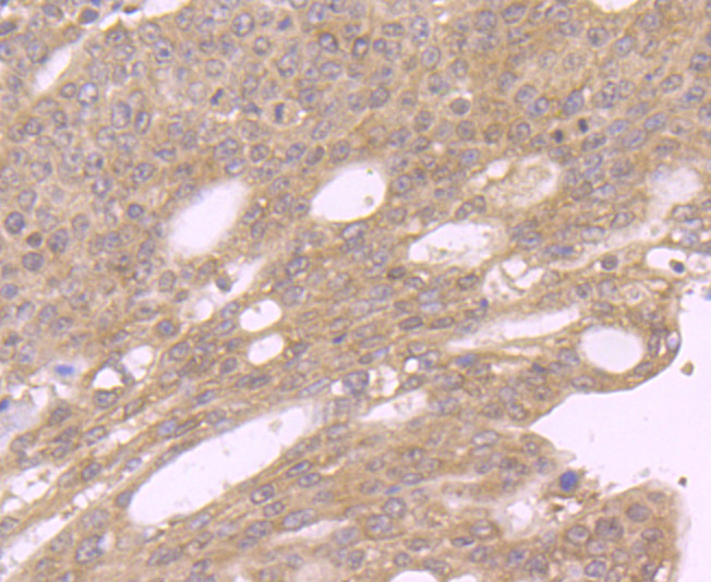 Immunohistochemical analysis of paraffin-embedded human stomach cancer tissue using anti-GOLPH3 antibody. Counter stained with hematoxylin.