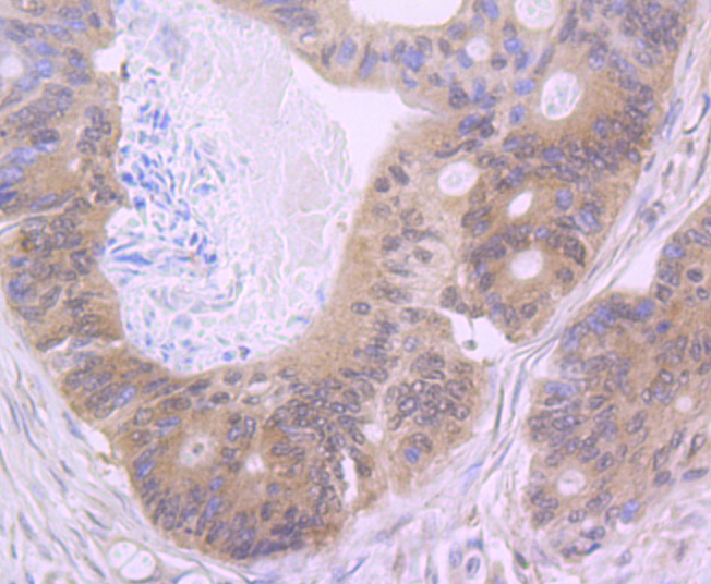Immunohistochemical analysis of paraffin-embedded human colon cancer tissue using anti-NLRC3 antibody. Counter stained with hematoxylin.