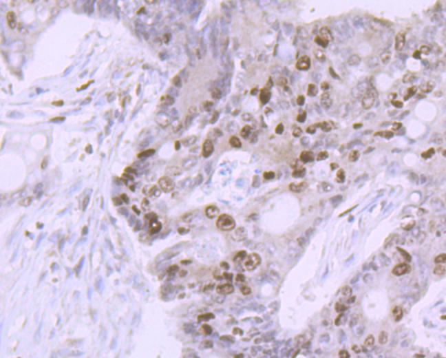 Immunohistochemical analysis of paraffin-embedded human colon cancer tissue using anti-Ki67 antibody. Counter stained with hematoxylin. The section was pre-treated using heat mediated antigen retrieval with sodium citrate buffer (pH6) for 20 mins.