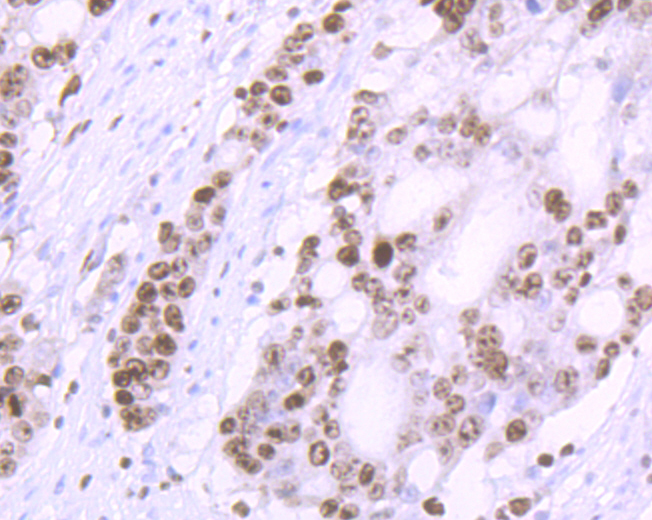 Immunohistochemical analysis of paraffin-embedded human stomach cancer tissue using anti-Ki67 antibody. Counter stained with hematoxylin. The section was pre-treated using heat mediated antigen retrieval with sodium citrate buffer (pH6) for 20 mins.