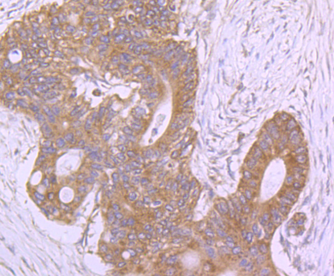 Immunohistochemical analysis of paraffin-embedded human colon cancer tissue using anti-ROCK2 antibody. Counter stained with hematoxylin.