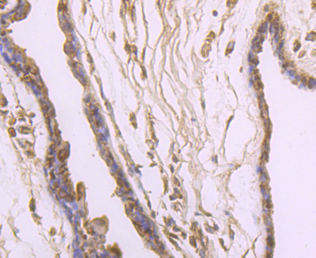 Immunohistochemical analysis of paraffin-embedded human breast cancer tissue using anti-IL4 antibody. Counter stained with hematoxylin.