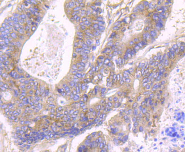 Immunohistochemical analysis of paraffin-embedded human colon cancer tissue using anti-JAK2 antibody. Counter stained with hematoxylin.