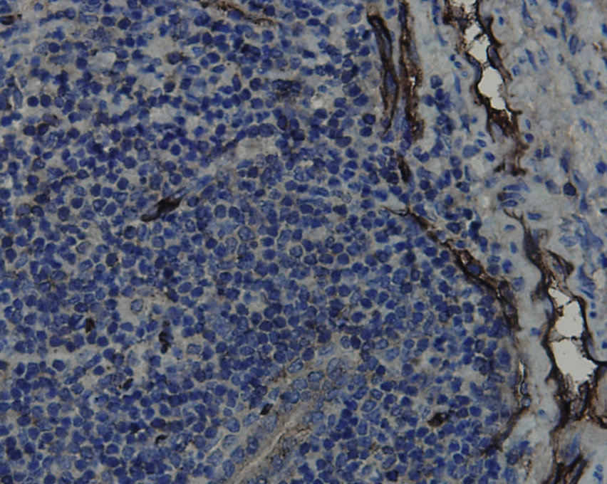 Immunohistochemical analysis of paraffin-embedded human liver cancer tissue using anti-CD34 antibody. Counter stained with hematoxylin.