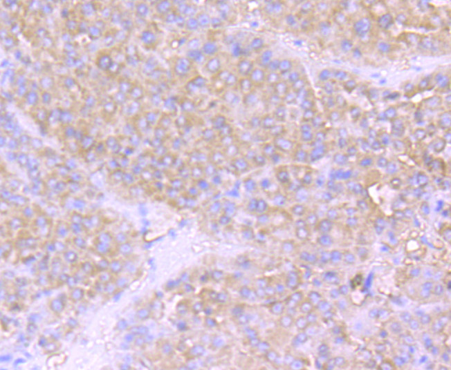 Immunohistochemical analysis of paraffin-embedded human liver cancer tissue using anti-NLRP3 antibody. Counter stained with hematoxylin.