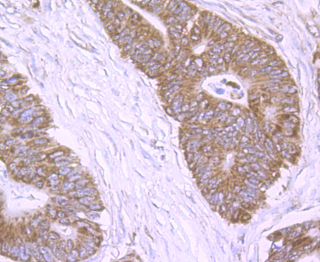 Immunohistochemical analysis of paraffin-embedded human colon cancer tissue using anti-NLRP3 antibody. Counter stained with hematoxylin.