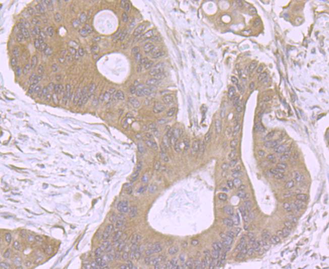 Immunohistochemical analysis of paraffin-embedded human colon cancer tissue using anti-MMP-3 antibody. Counter stained with hematoxylin.