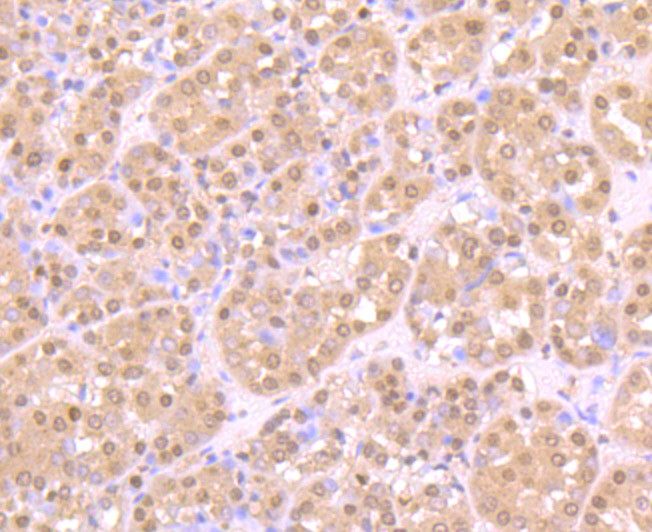 Immunohistochemical analysis of paraffin-embedded human liver cancer tissue using anti-ZBTB48 antibody. Counter stained with hematoxylin.