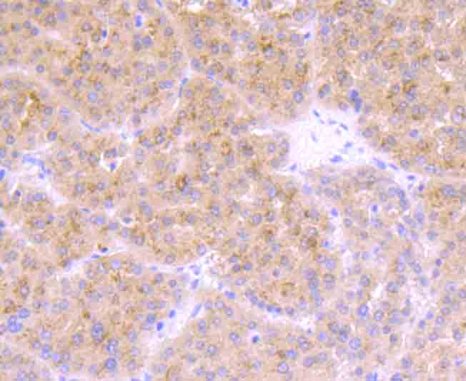 Immunohistochemical analysis of paraffin-embedded human liver cancer tissue using anti-TrkA antibody. Counter stained with hematoxylin.