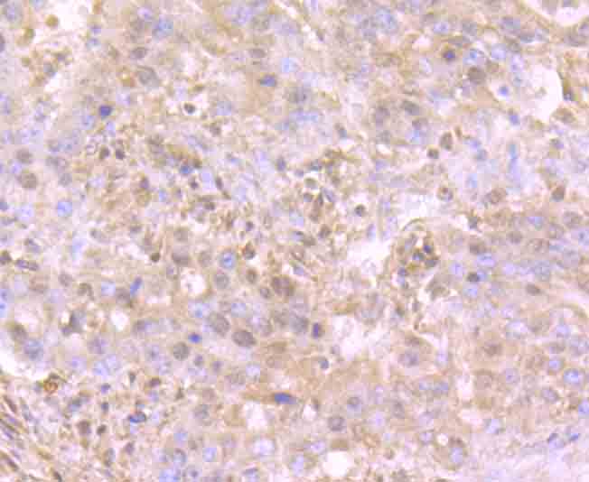 Immunohistochemical analysis of paraffin-embedded human stomach cancer tissue using anti-TrkA antibody. Counter stained with hematoxylin.