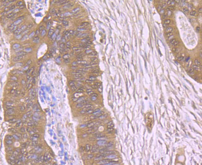 Immunohistochemical analysis of paraffin-embedded human colon cancer tissue using anti-PBR antibody. Counter stained with hematoxylin.