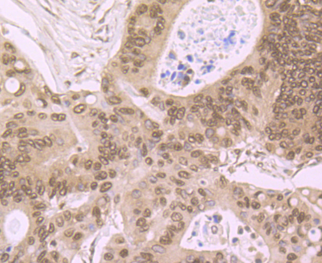 Immunohistochemical analysis of paraffin-embedded human colon cancer tissue using anti-LSD1 antibody. Counter stained with hematoxylin.