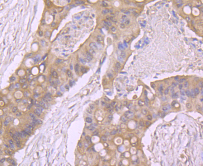 Immunohistochemical analysis of paraffin-embedded human colon cancer tissue using anti-beta Arrestin 1 antibody. Counter stained with hematoxylin.